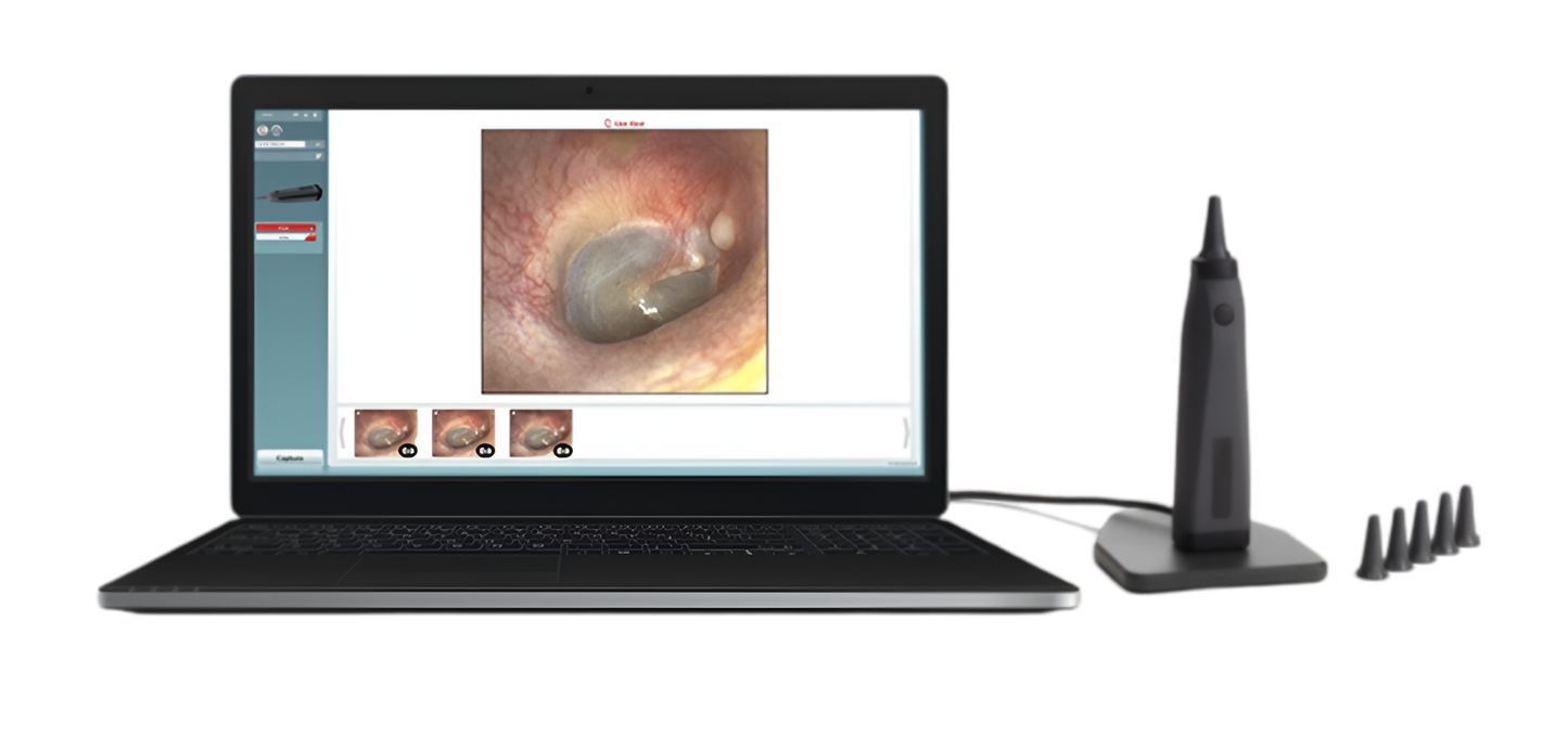 Otoscopio Viot™ de Beracah Medica mostrando la punta y lentes para inspección de oído en una imagen clara.