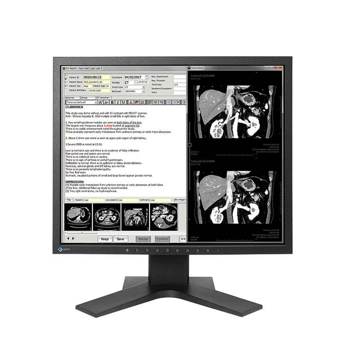 Monitor clínico Beracah Medica de 19 pulgadas, revisión diagnóstica, pantalla color 1280x1024, 1.3MP, para diagnóstico médico.