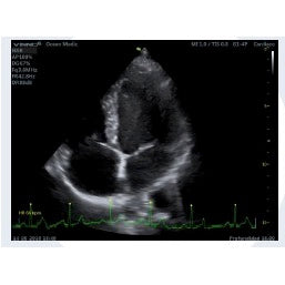 Módulo ECG para ultrasonido Vinno de Beracah Médica, dispositivo compacto y conectado para análisis cardíaco en ultrasonido.