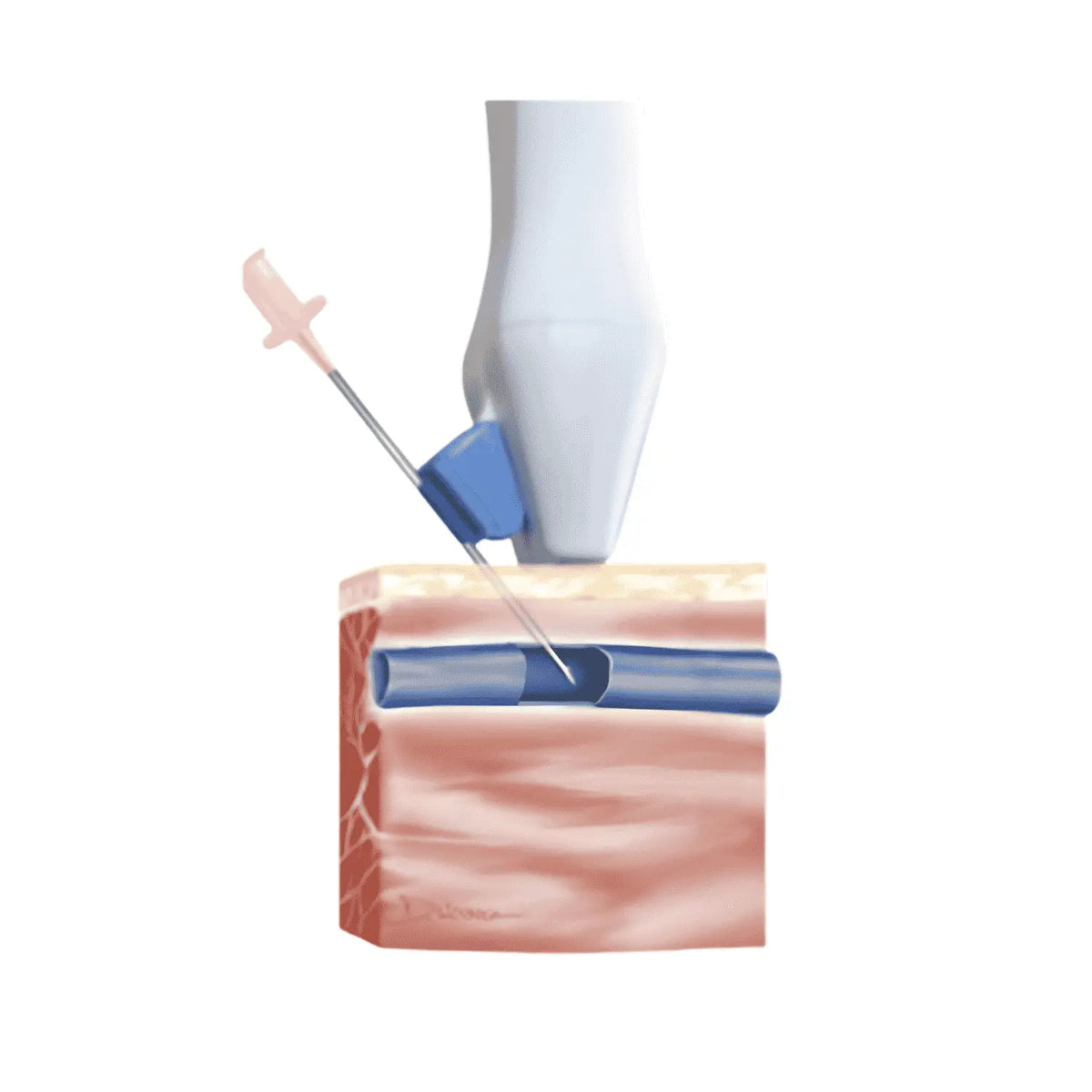 Set con aguja, guía y gel Sheath para Site rite™ de Beracah Medica, accesorios para ultrasonidos, 15x122cm