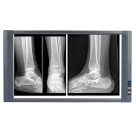 Negatoscopio doble LED MSI de Beracah Medica con iluminación de más de 6500 K, diseñado para radiografías y imágenes médicas.