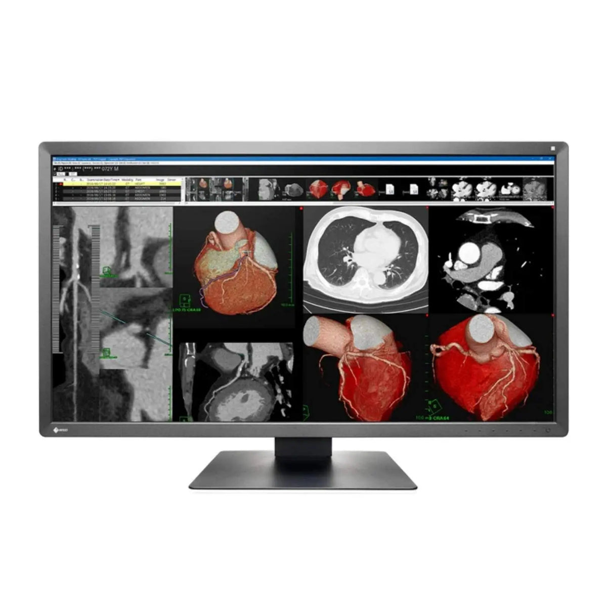 Monitor de revisión clínica Radiforce 8MP de 30.5" en color, resolución 4K para diagnóstico médico, marca Beracah Medica.